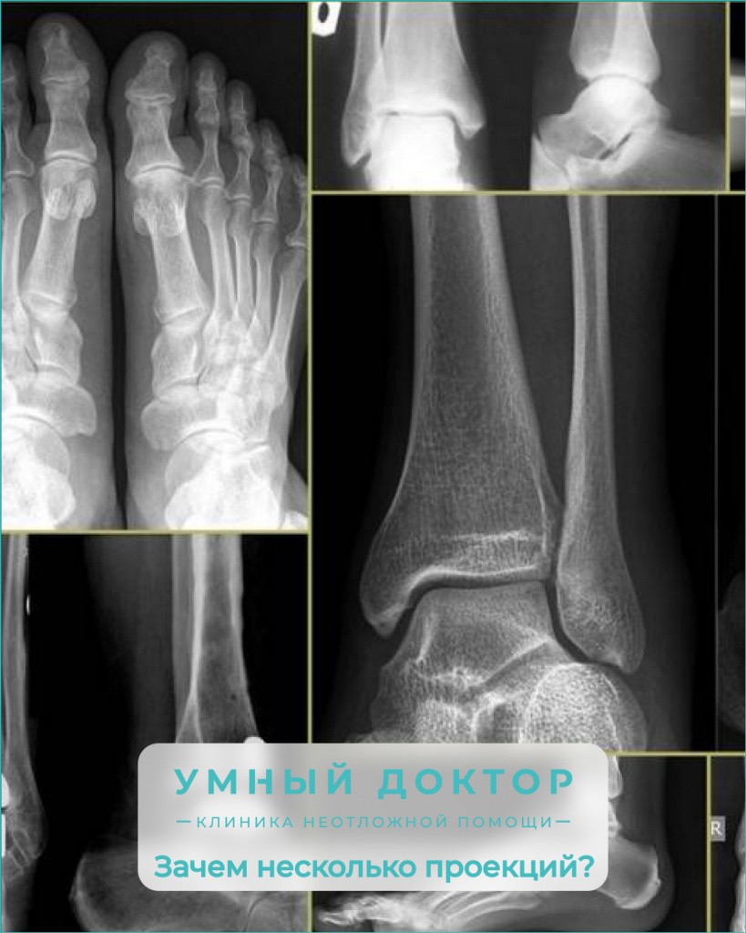 Зачем нужны рентгеновские снимки в двух и трех проекциях при травмах?